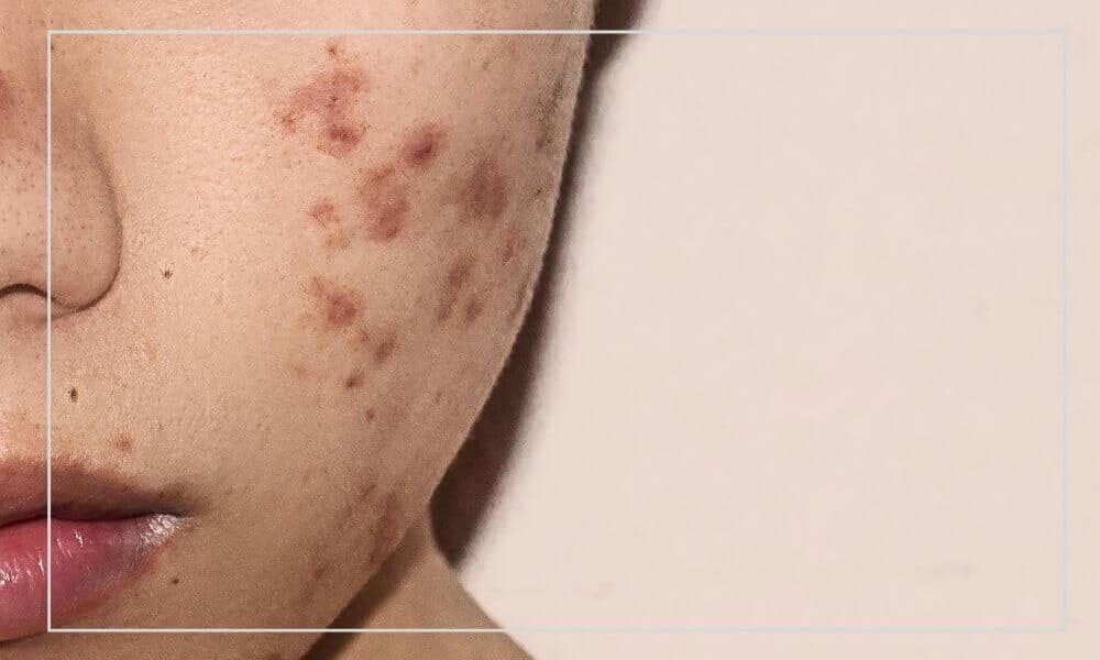 Kwas Szikimowy w Pielęgnacji Skóry