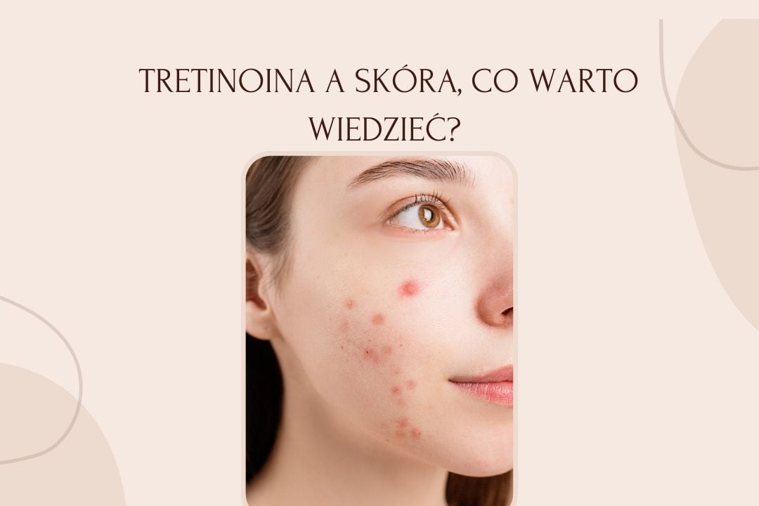 Tretinoina a skóra, co warto wiedzieć? Wartościowa wiedza na temat działania i zastosowania