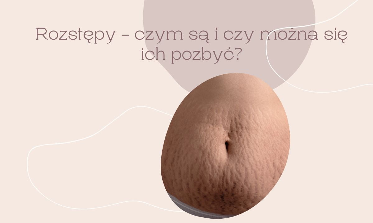Rozstępy – czym są i czy można się ich pozbyć?